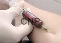 test - Center News Network Medical professional wearing gloves drawing blood from a patient's arm with a syringe (blood draw). If context is a clinical setting, this indicates a blood sample collection.
